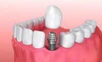 Как проводится одномоментная имплантация зубов
