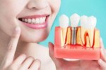 Имплантация зубов – лучший способ вернуть себе безупречную улыбку