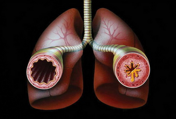 Бронхиальная астма - описание Бронхиальная астма - описание 