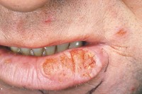 Причины возникновения и лечение рака губы